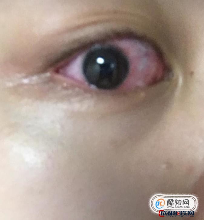 戴美瞳的优点和缺点