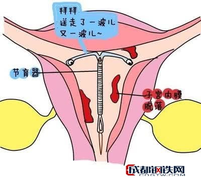 节育环在宫腔内的图片图片
