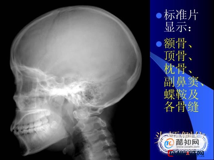 01頭顱正位:攝影目的:觀察顱骨的骨質,對稱性,骨板厚度及顱內的情況.